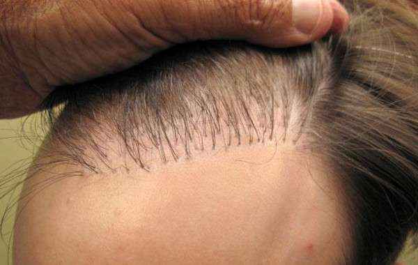 HFE пересадка волос. Фото, как делается операция, цена, отзывы