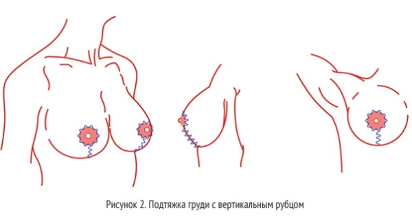 Методы подтяжки груди. Виды операции, как делается, фото до и после