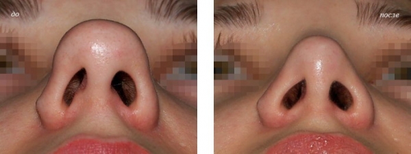 Ринопластика кончика носа. Цена, отзывы