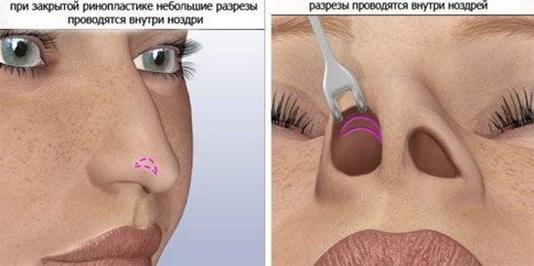 Ринопластика кончика носа. Цена, отзывы
